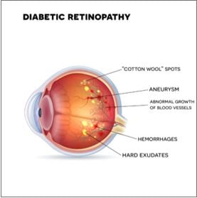 Diabetic Retinopathy