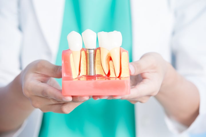 What You Need to Know About Dental Implants