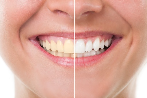 What's the Bleaching Truth on Teeth Whitening