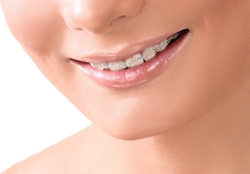 braces, too old for braces think again, oral health, dental insurance, dental health, never too old for braces