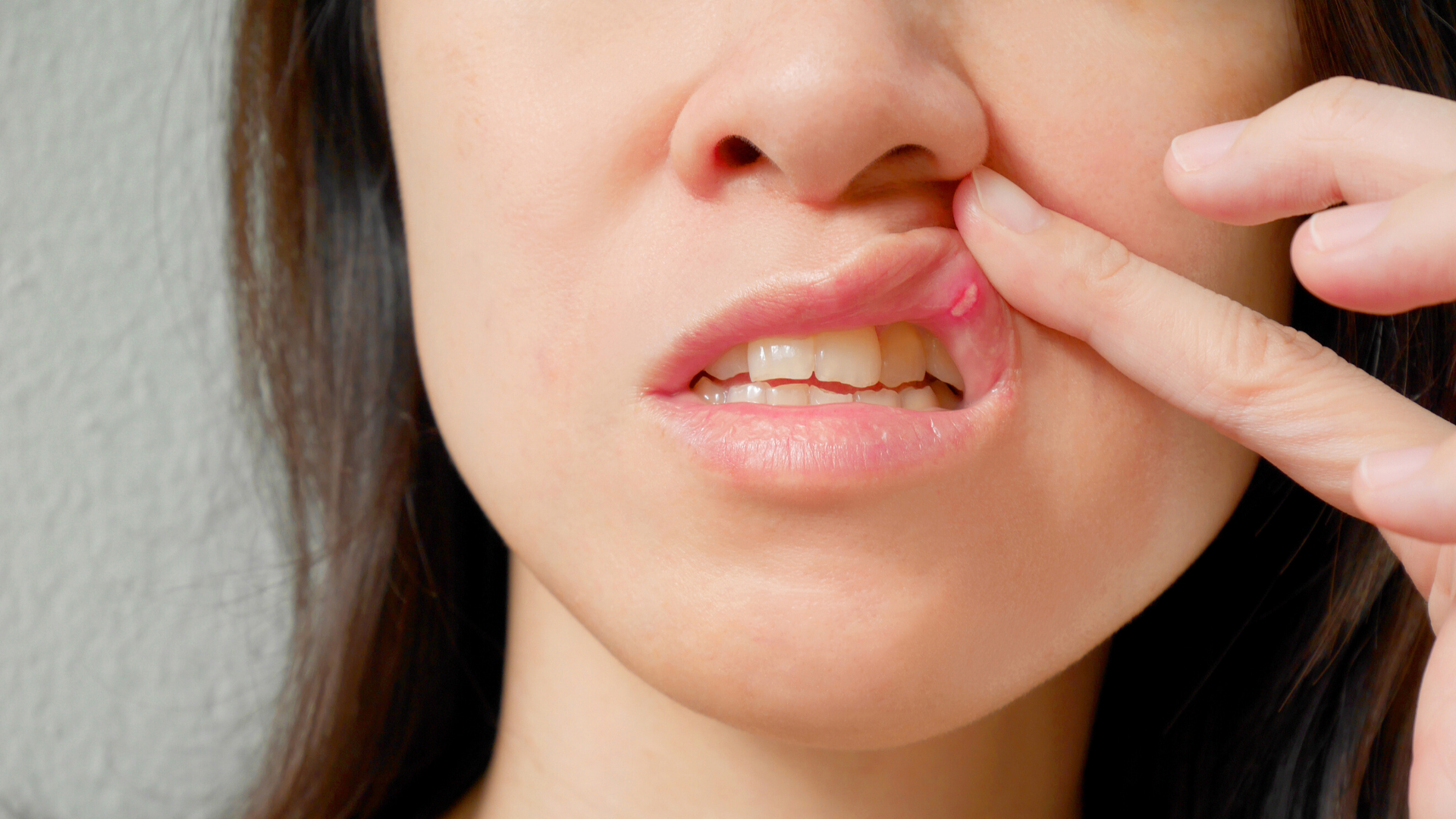 Women showing her canker sore on her upper lips