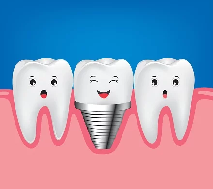 does dental insurance cover implants-1