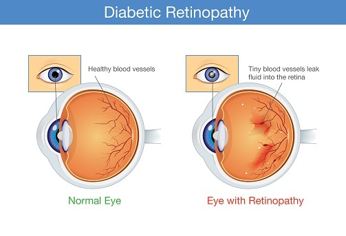 eye diseases; what is diabetic retinopathy