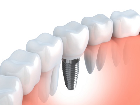 why did my dental implant fail